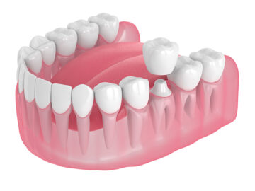 Dental Crowns 101: Everything You Need to Know 