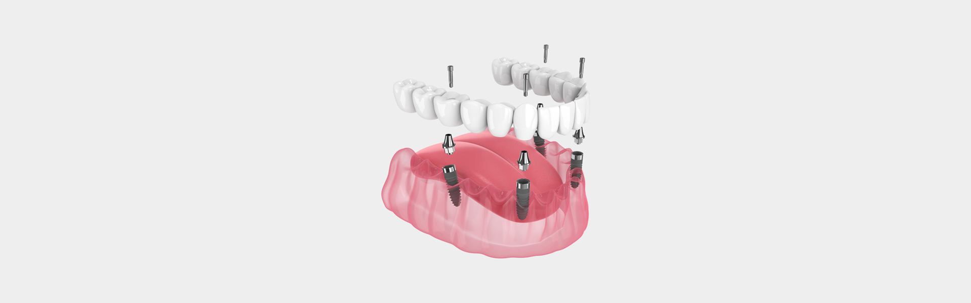 All on 4 Implants at ON Pointe Dentistry in Phoenix, AZ
